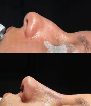 antes e depois procedimentos