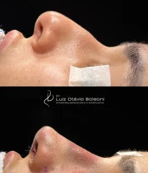 antes e depois procedimentos